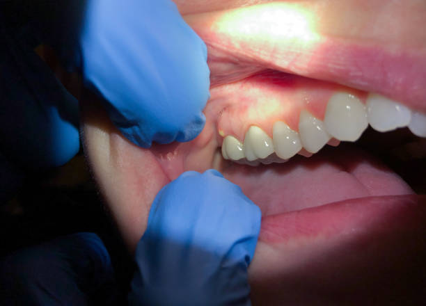 Best Lost Filling or Crown Replacement in Tolono, IL